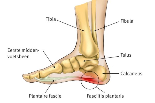 Fasciitis plantaris