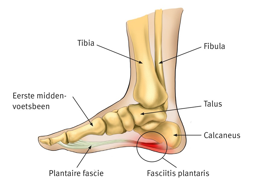 Fasciitis plantaris