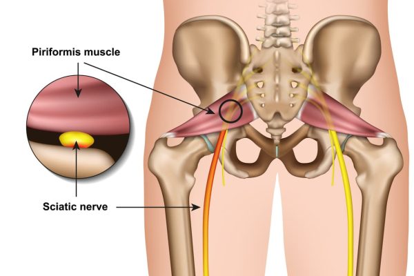 Piriformis syndroom