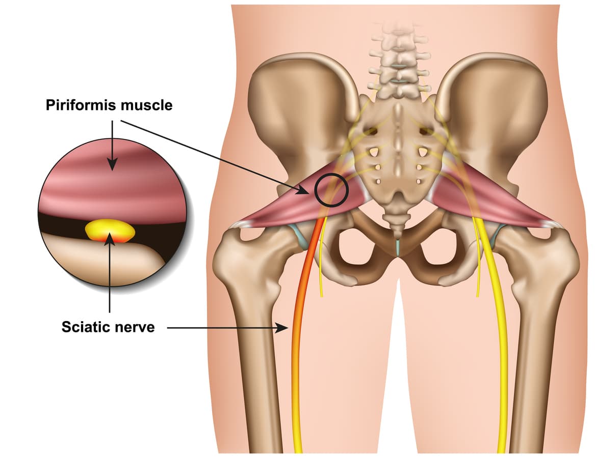 Piriformis syndroom